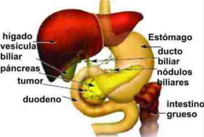 tumor pancreas