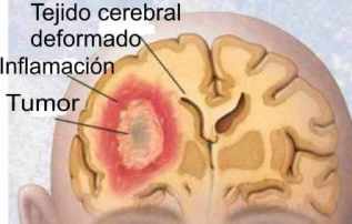 tumor cerebral clinica mayo