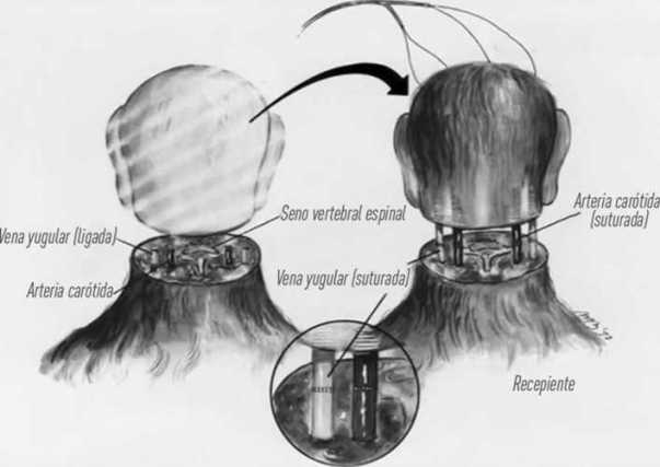 trasplante teorico cabeza