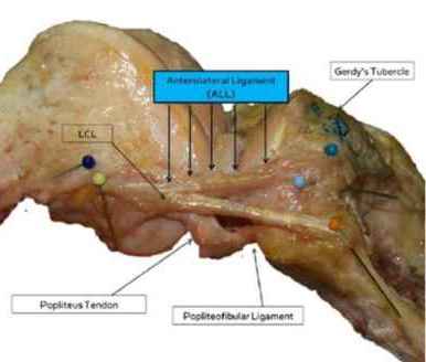 ligamento anterolateral