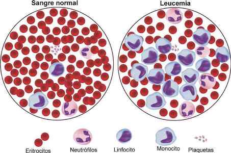 sangre normal leucemia