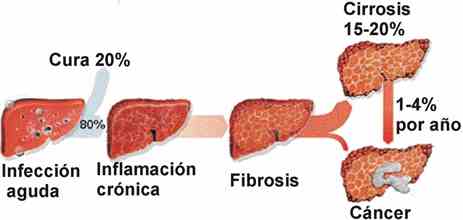 Hepatitis C