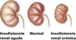 insuficiencia renal