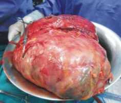 tumor renal 10kg