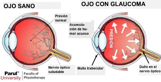 glaucoma 3