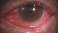 ojo_conjuntivitis.jpg