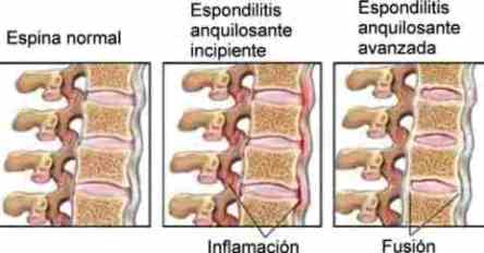 espondilitis anquilosante