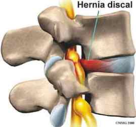 hernia discal