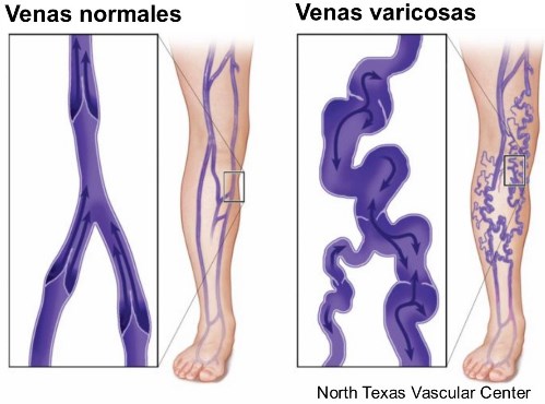 varices