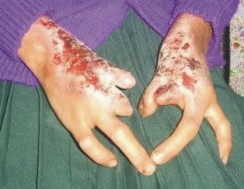 choropampa manos afectada