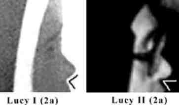 nariz perfil Lucia I Lucia II