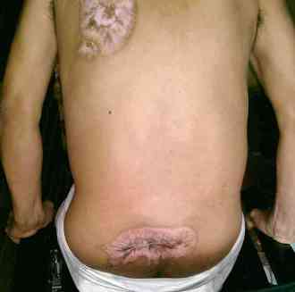 Humberto Vasquez paraplejia