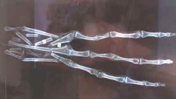 radiografia mano gigante Peru