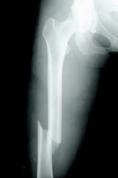fractura femur rx