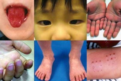 sindrome kawasaki