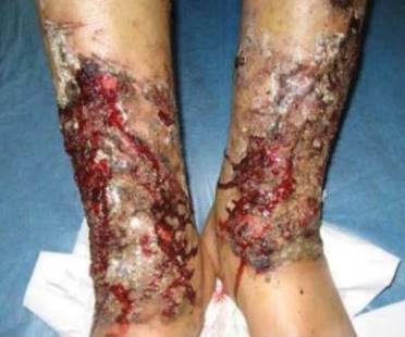 ulceras piernas paraquat Spandidos