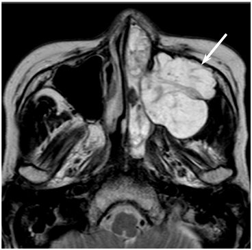 Adenoid cystic carcinoma left maxillary sinus and nasal cavity Gifu University