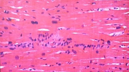 Reutlingen 10 epicarditis linfocitos y granulocitos