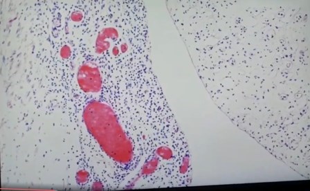 Reutlingen 11 epicardio infiltracion linfocitos