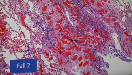 Reutlingen 12 dano alveolar difuso colapso pulmon