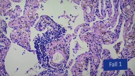 Reutlingen 13 alglomeracion linfocitos alrededor vaso pulmon