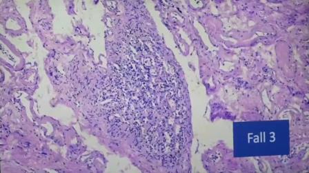 Reutlingen 14 foliculos pulmon