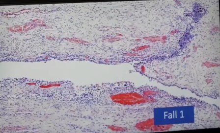 Reutlingen 15 pulmon dano no definido