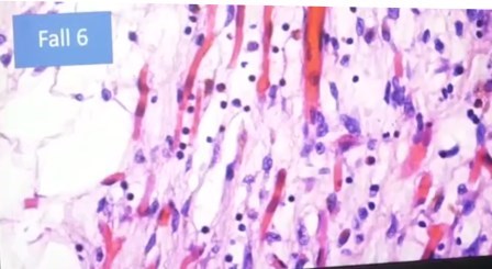 Reutlingen 17 endotelitis