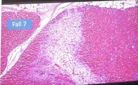 Reutlingen 18 foco infeccion vasos y multiple