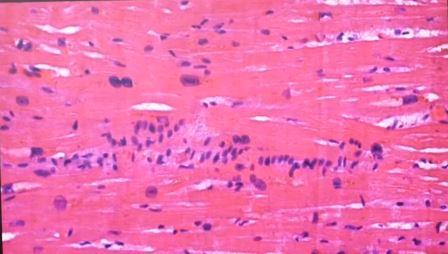 Reutlingen 19 ampliacion foco infecion vasos y multiple