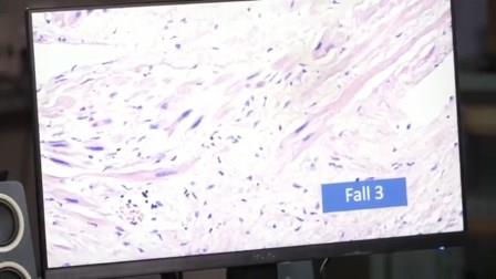 Reutlingen 1 destruccion de fibra muscular