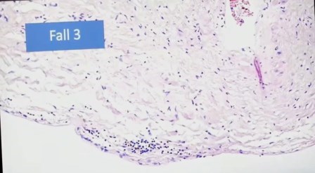 Reutlingen 20 epicarditis