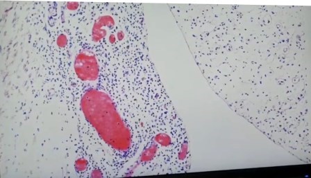 Reutlingen 21 epicardio con infiltracion de linfocitos