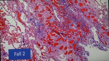 Reutlingen 22 atelectasis pulmon colapsado