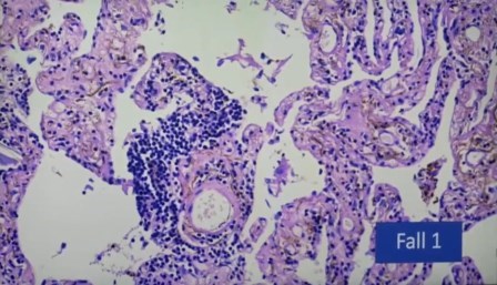 Reutlingen 22 atelectasis pulmon colapsado