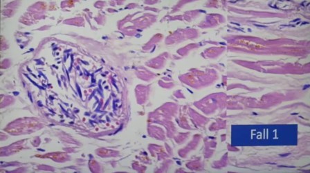 Reutlingen 24 aglomeracion de linfocitos en estudio