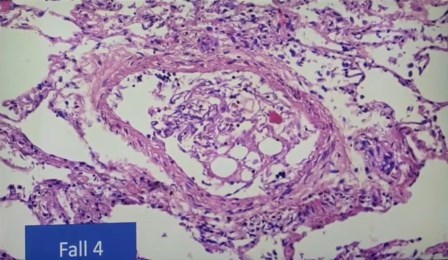 Reutlingen 26 no se pudo interpretar pulmon