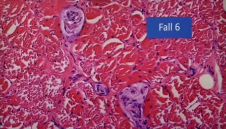 Reutlingen 27 sin interpretar pulmon