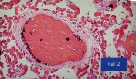 Reutlingen 28 eritrocitos grumos