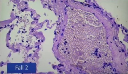 Reutlingen 29 eritrocitos normales separados
