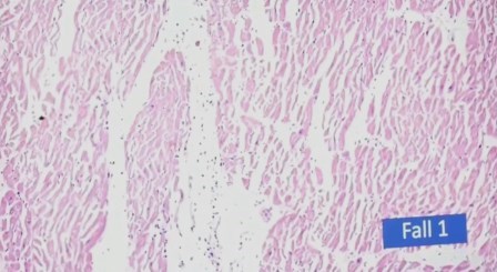 Reutlingen 2 linfocitos fibra muscular cardiaca