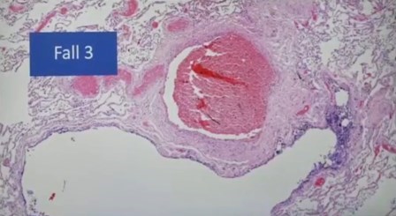 Reutlingen 30 eritrocitos en grumos inflamacion vena pulmonar