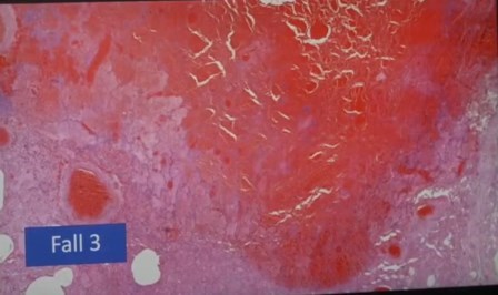 Reutlingen 32 linfocitos en infarto pulmonar