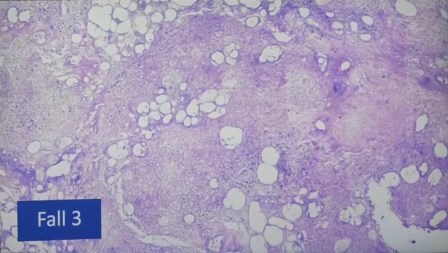 Reutlingen 33 necrosis pancreas con infiltracion linfocitos