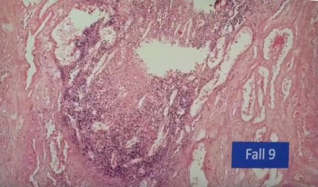 Reutlingen 34 vaso con infiltracion de linfocitos