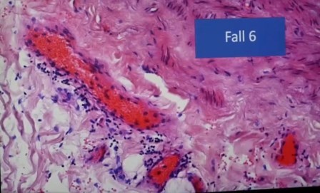 Reutlingen 35 linfocitos en aorta