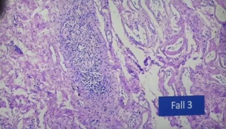 Reutlingen 37 bronculo foliculo