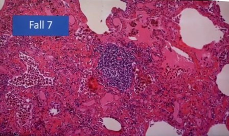 Reutlingen 38 foliculo de linfoma con 2 focos