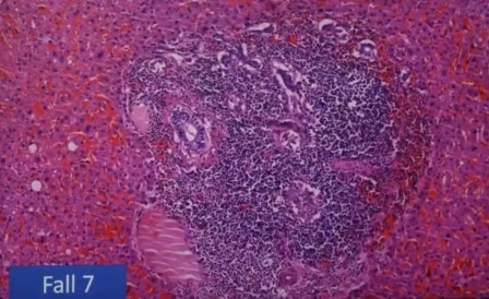 Reutlingen 38 infiltracion linfocitos en el higado