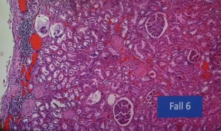 Reutlingen 40 infiltracion nefritis intersticial